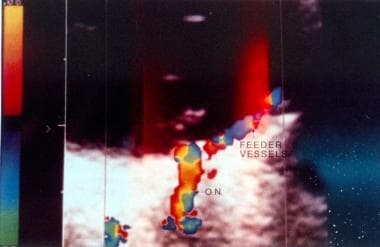 von Hippel-Lindau disease. Color Doppler image of 