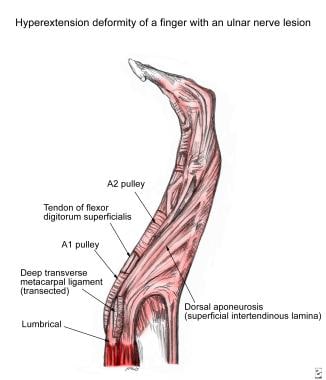 Hyperextension deformity in ulnar nerve paralysis.
