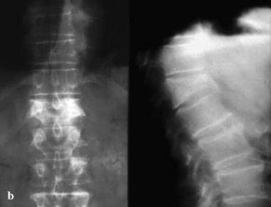 Anteroposterior and lateral radiographs of an L1 o