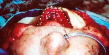 AFC Surgical Photo Database - Aesthetic Flat Closure