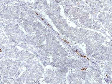 The image shows a sertoliform endometrioid carcino