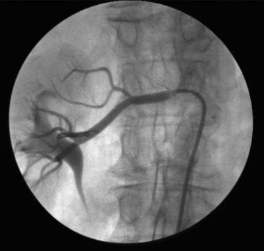 Angiogram obtained after percutaneous transluminal