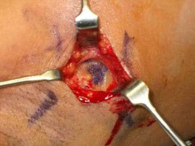 The incision leads to a blue lymph node. Note the 