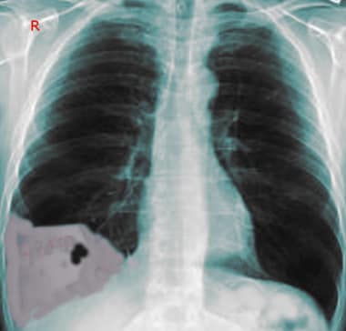 A 23-year-old man with a stab to the right chest p