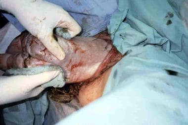Assisted vaginal breech delivery. After the scapul