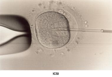 Infertility. Intracytoplasmic sperm injection. Ima