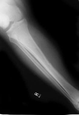 脊髓型骨质疏松患者的股骨