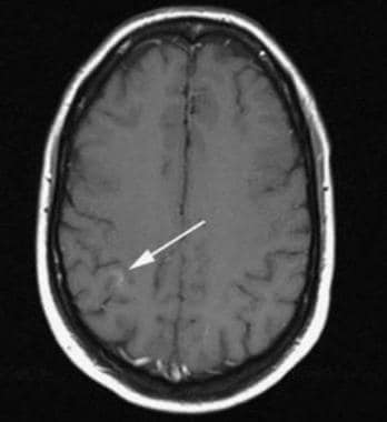 Axial contrast-enhanced T1-weighted MRI demonstrat