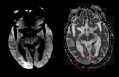 The right posterior cerebral artery (PCA) distribu