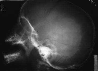Lateral skull radiograph in a child shows a long, 