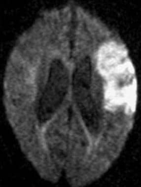 Axial DWI image demonstrates a typical wedge-shape