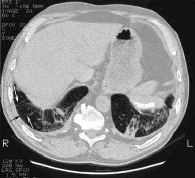 Asbestosis. High-resolution CT scan through the lo