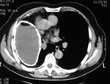 Computed tomography (CT) scan (mediastinal window)