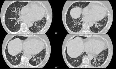 High-resolution CT (HRCT) shows distortion of the 