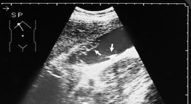Longitudinal oblique ultrasonogram through the gal