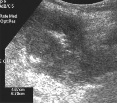 Ultrasound scan of a large cecal carcinoma showing