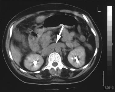 Contrast-enhanced axial CT scan shows a dilated le