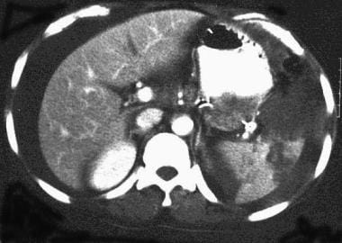 Spleen, trauma. Contrast-enhanced CT scan of the a