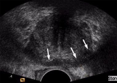 Axial transrectal sonogram in a patient with norma