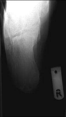 Calcaneus, fractures. Plain radiograph. 