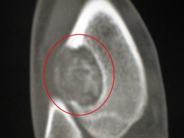 CT scan of the distal tibia of a 16-year-old boy r