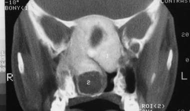 Coronal image shows craniofacial fibrous dysplasia