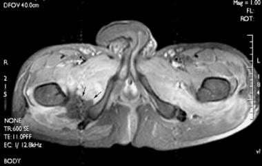 Axial, spin-echo, T1-weighted, fat-suppressed magn