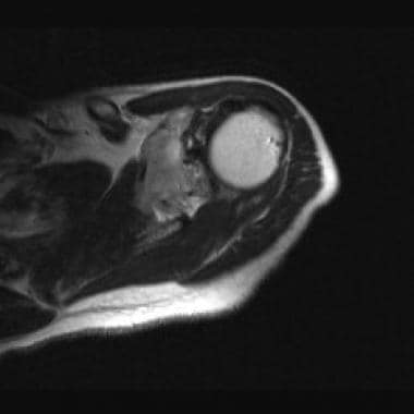 A T1-weighted magnetic resonance image of the shou