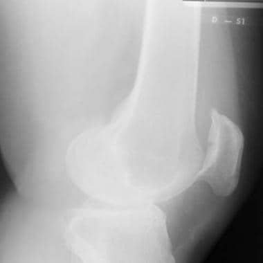 Radiograph of a nondisplaced transverse fracture o