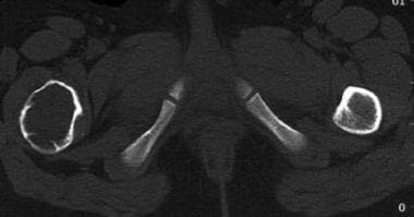 CT scan reveals a simple bone cyst in the upper me
