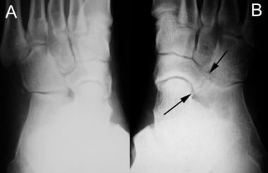 Medial oblique radiographs of both feet in a patie