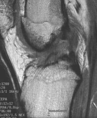 Partial tear of the ACL. T1-weighted sagittal MRI 