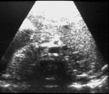 Preduodenal portal vein. Transverse ultrasonogram 