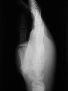 Skeletal sickle cell anemia. Radiograph of osteomy