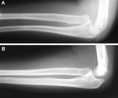 Monteggia fracture type I. Lateral view of injured