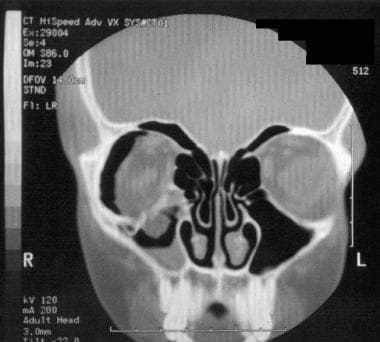 CT scan depicts a "tear-drop" sign that is indicat