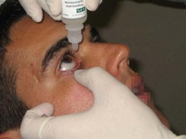 Application of anesthetic ophthalmic solution. 