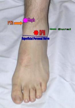 Areas of anesthetization to complete an ankle bloc