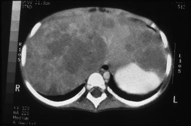 CT scan showing a hepatoblastoma present in multip