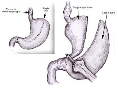 Creation of stomach tube 