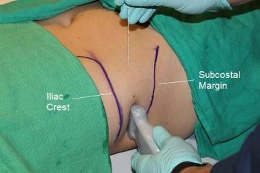 Positioning of the patient and ultrasound probe fo
