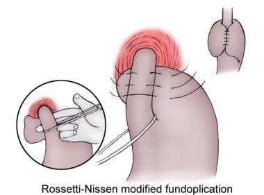 Rossetti-Nissen modified fundoplication. 
