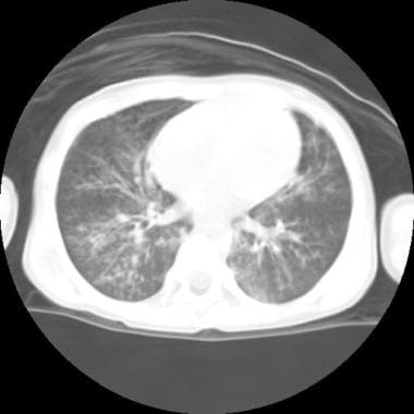 CT scan of the chest of a child with bronchiectasi