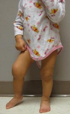 Eighteen-month-old girl with arthritis in her righ