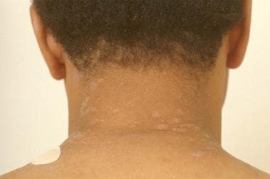 Lichen planus on the neck. 