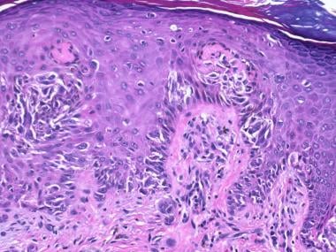 This Spitz nevus shows large melanocytes with spin