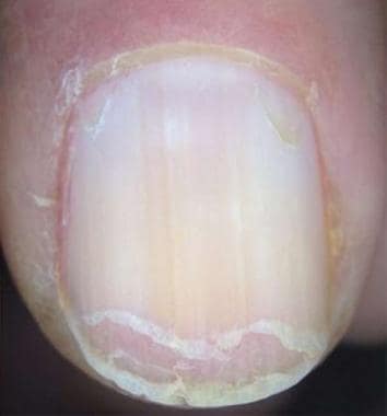 Brittle nail syndrome: Horizontal splitting of the