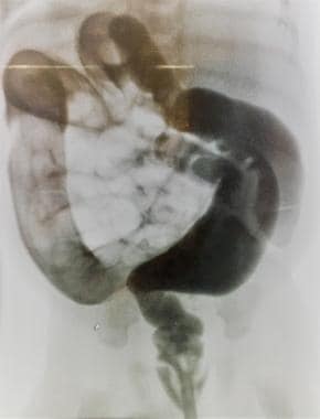 Intestinal obstruction in the newborn. The contras
