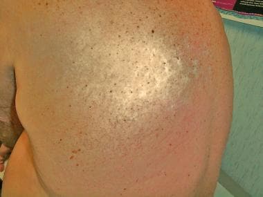 Hypopigmented rash in thoracic dermatome of posthe