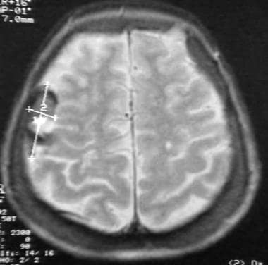 Case 1: MRI of a meningioma on plaque. 